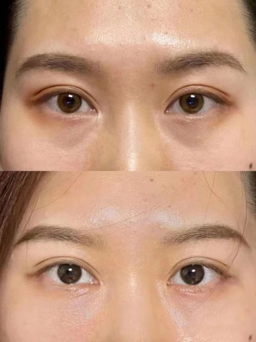 霜！去眼袋最有效的眼霜top5j9九游会登录去眼袋第一名的眼(图3)